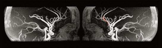 TRACT – Inverted Tree TRACT – Inverted Tree